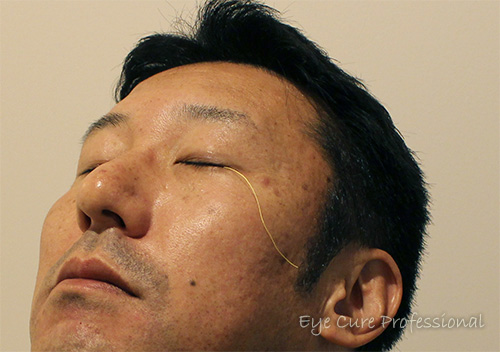 綿糸法による涙液測定