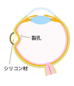 硝子体